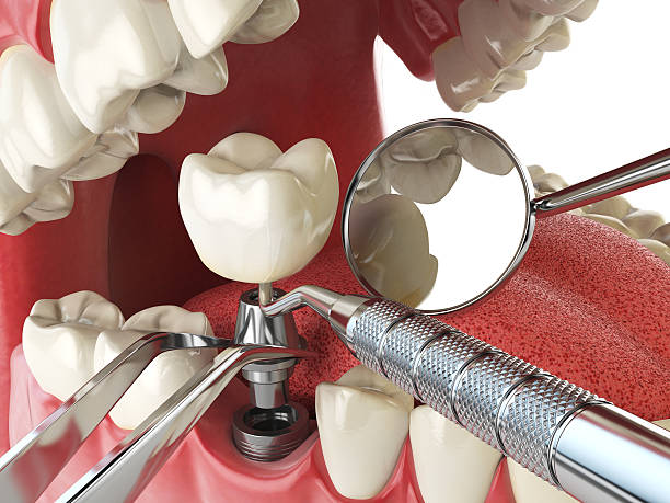 Best Emergency Wisdom Tooth Extraction in Wyndham, VA